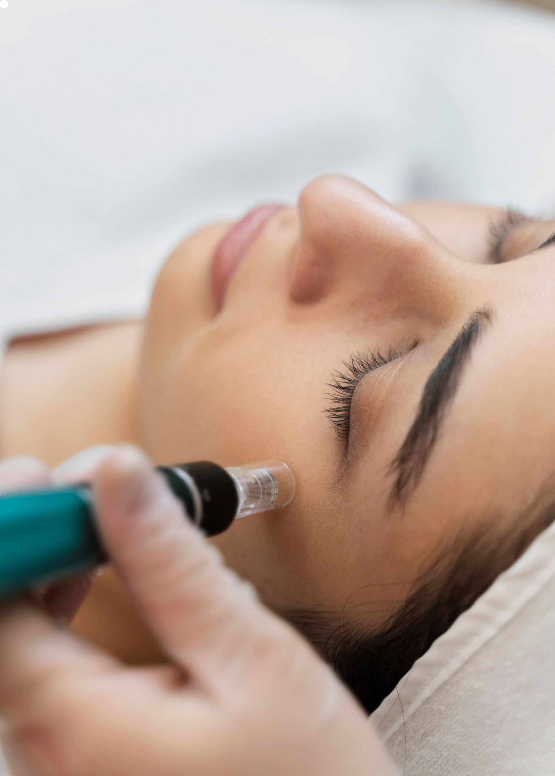 Untitled design (1) Woman laying on a table receiving a microneedling procedure